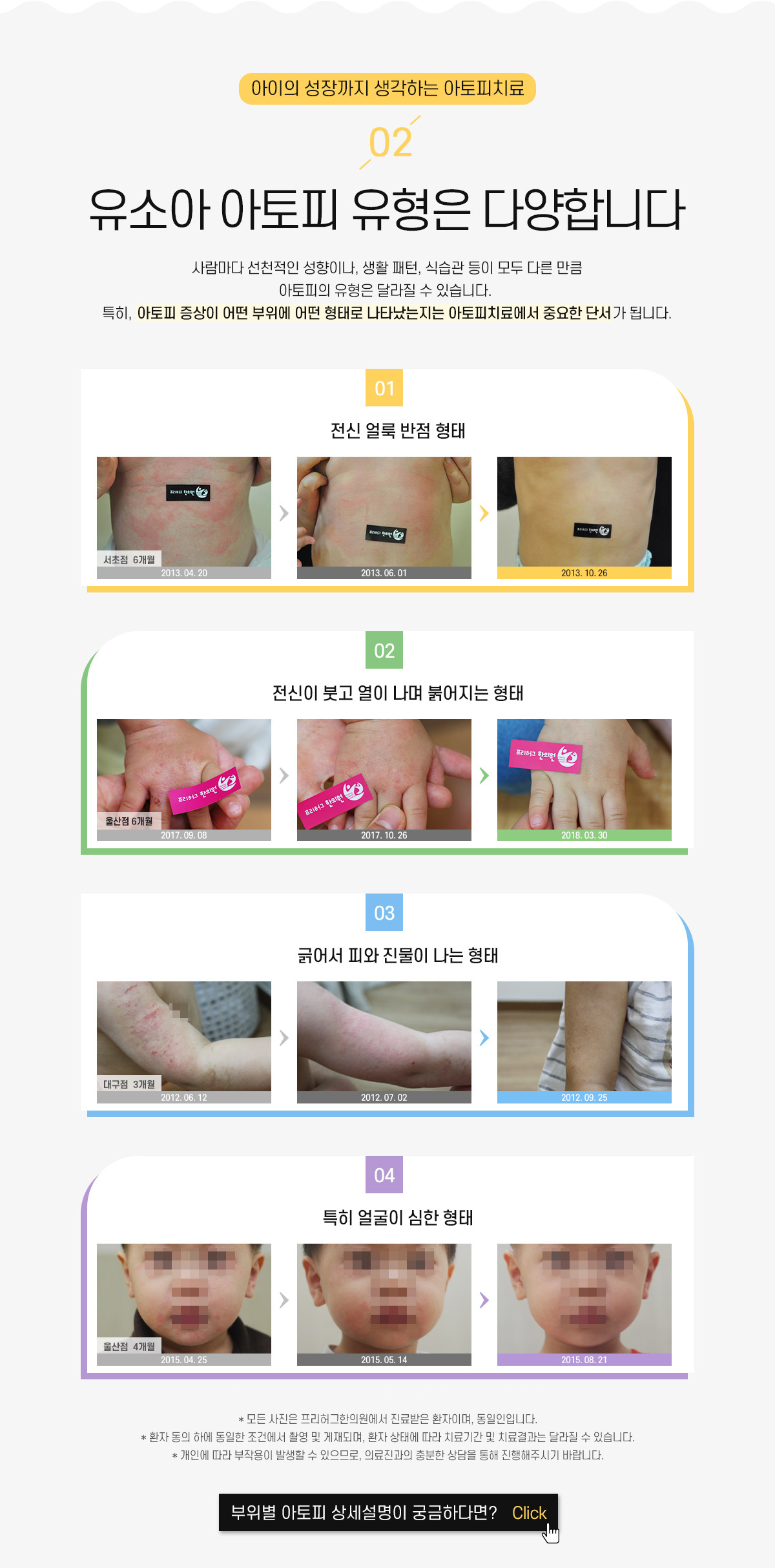 2. 유소아 아토피 유형은 다양합니다