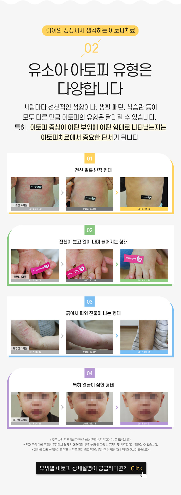 2. 유소아 아토피 유형은 다양합니다