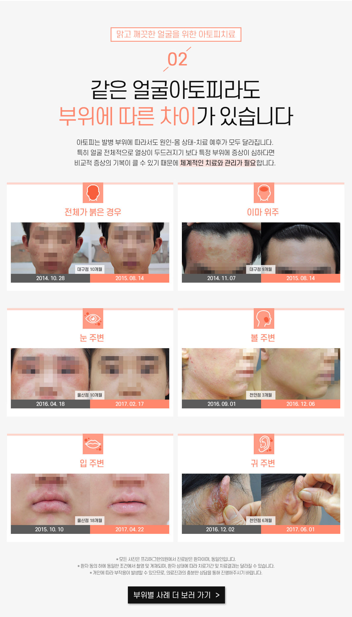 2. 같은 얼굴아토피라도 부위에 따른 차이가 있습니다