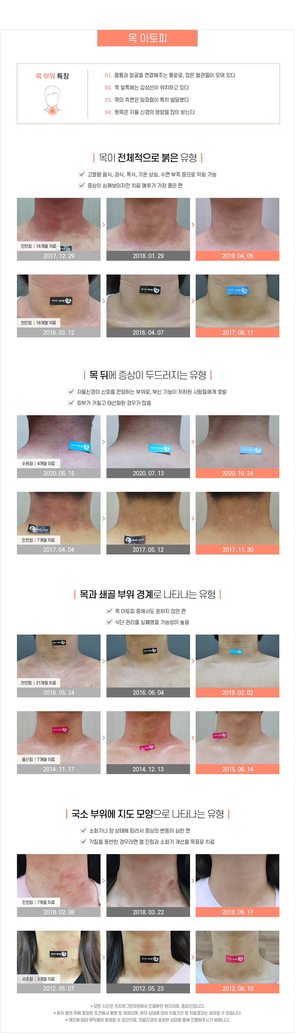 목 아토피