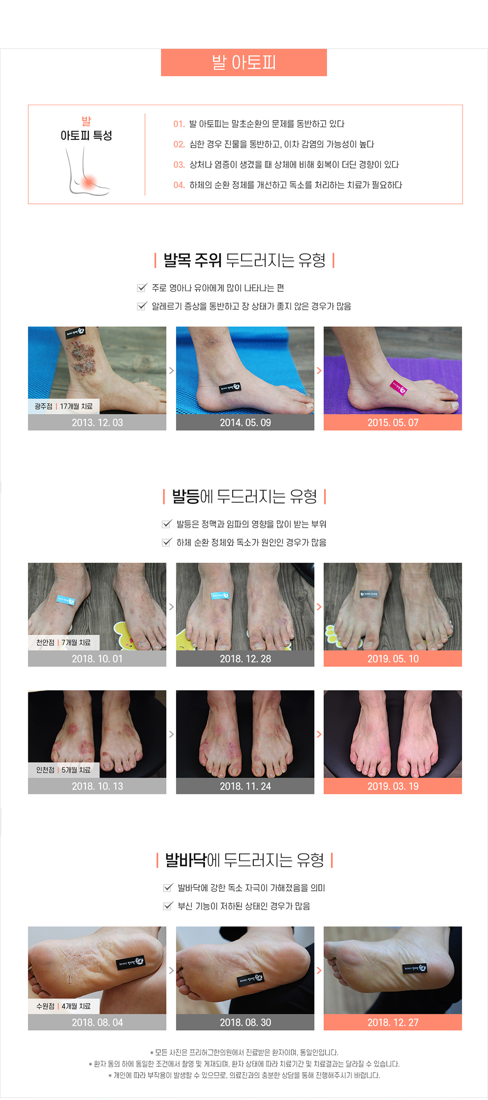 발 아토피
