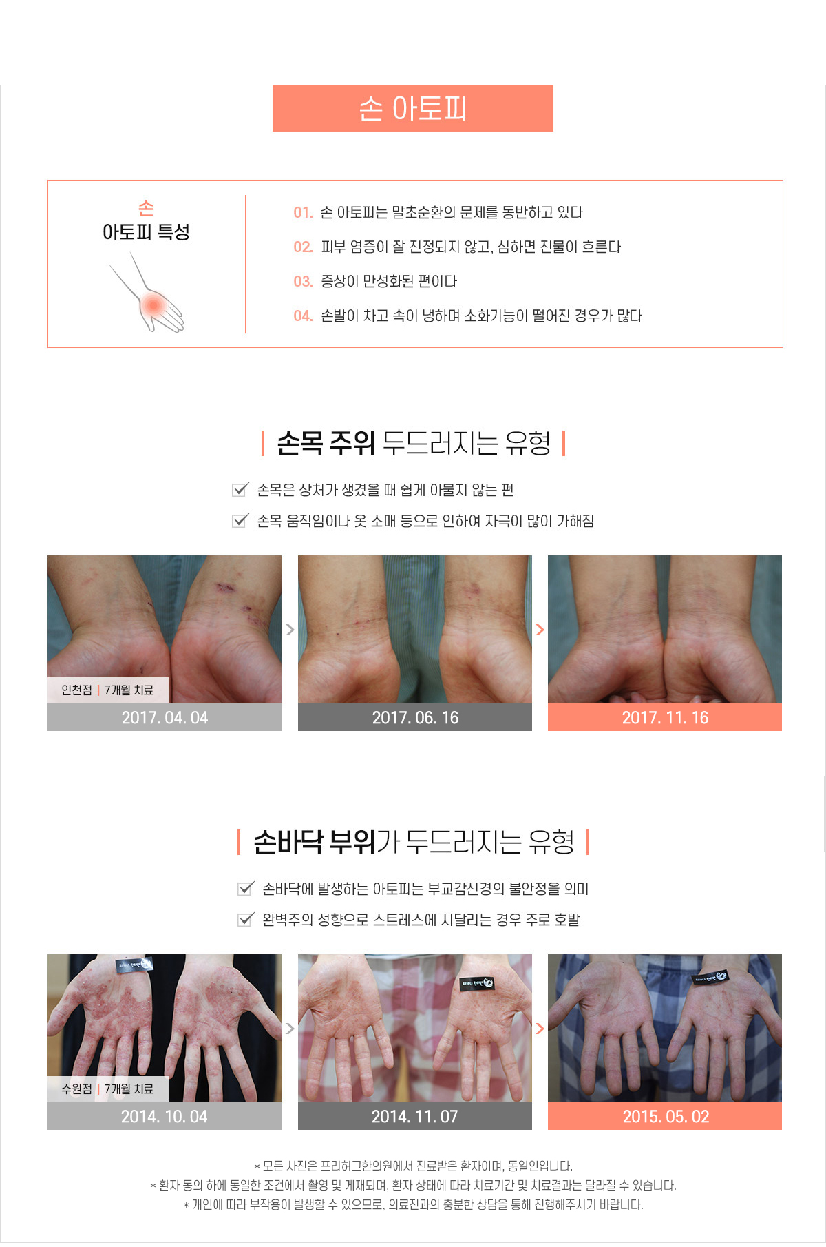 손 아토피