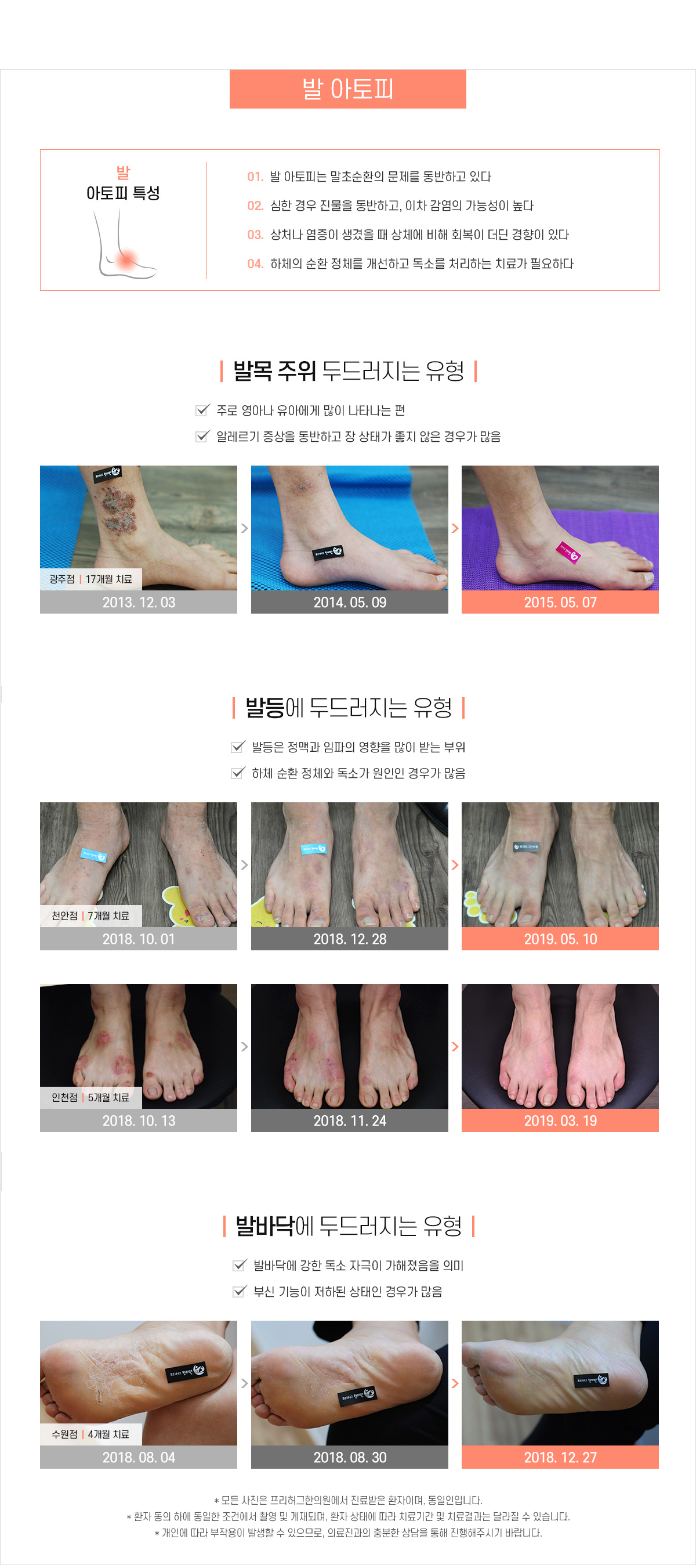 발 아토피