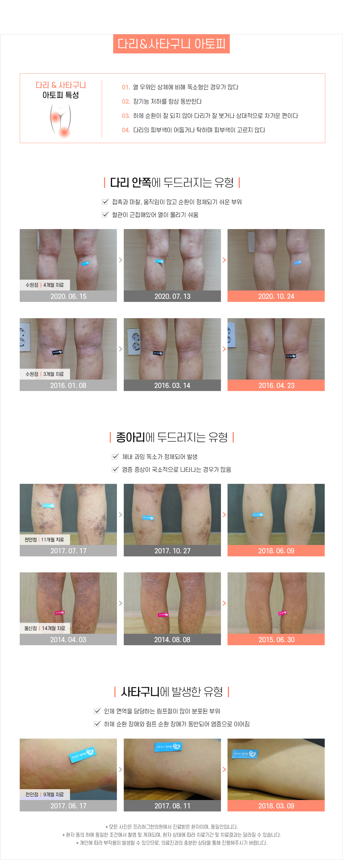 다리/사타구니 아토피