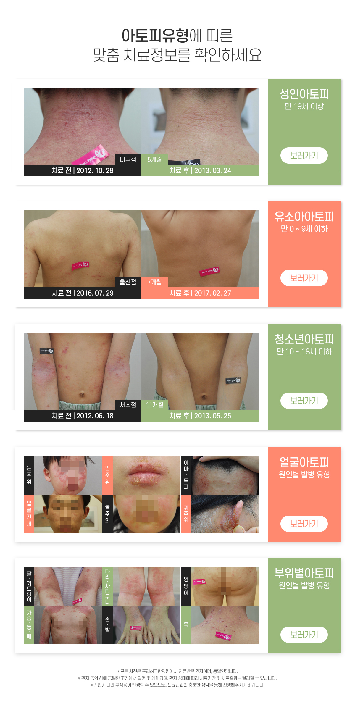 아토피 유형에 따른 맞춤 치료정보