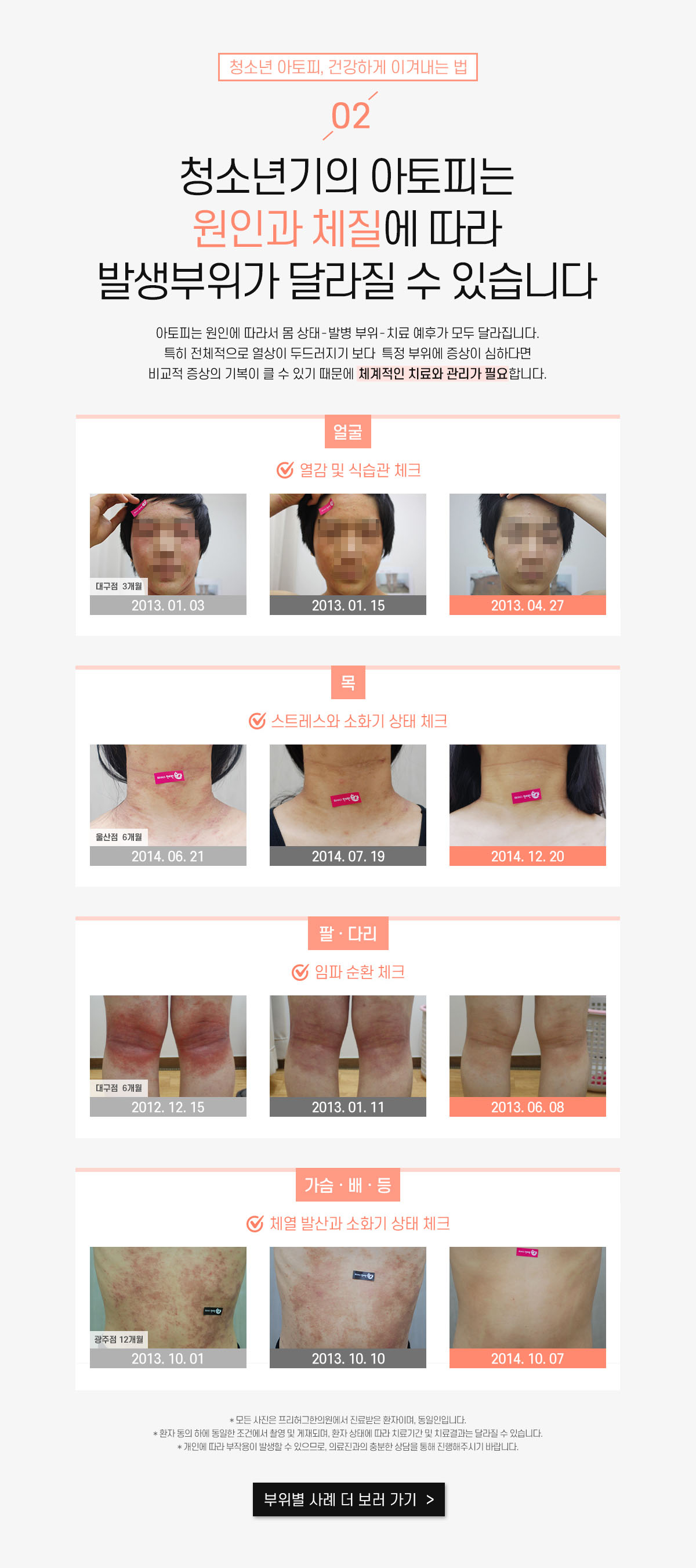2. 청소년기의 아토피는 원인과 체질에 따라 발생부위가 달라질 수 있습니다