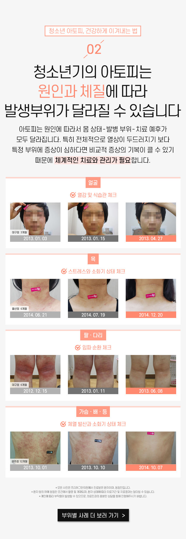 2. 청소년기의 아토피는 원인과 체질에 따라 발생부위가 달라질 수 있습니다