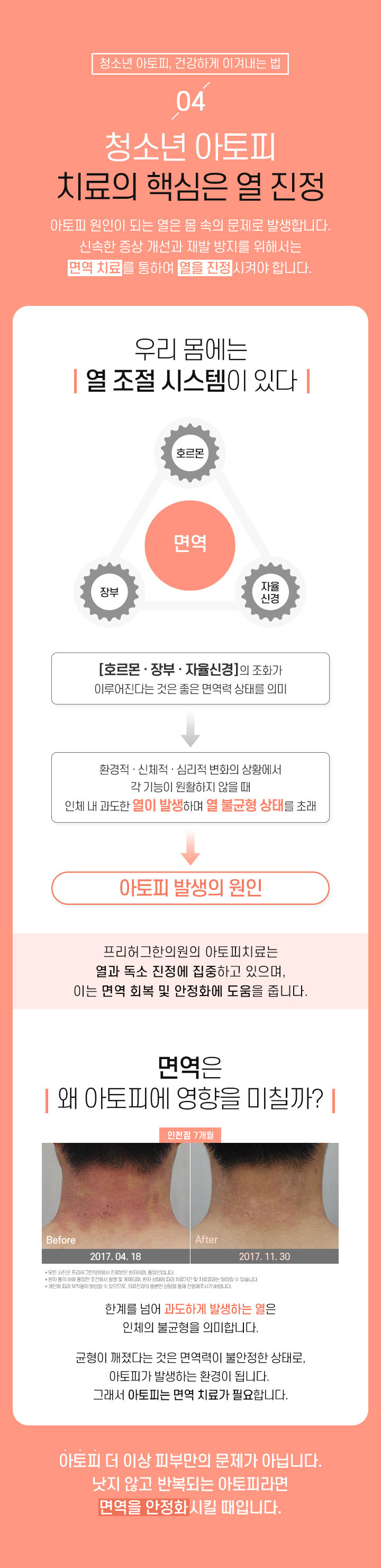 4. 청소년 아토피 치료의 핵심은 열 진정