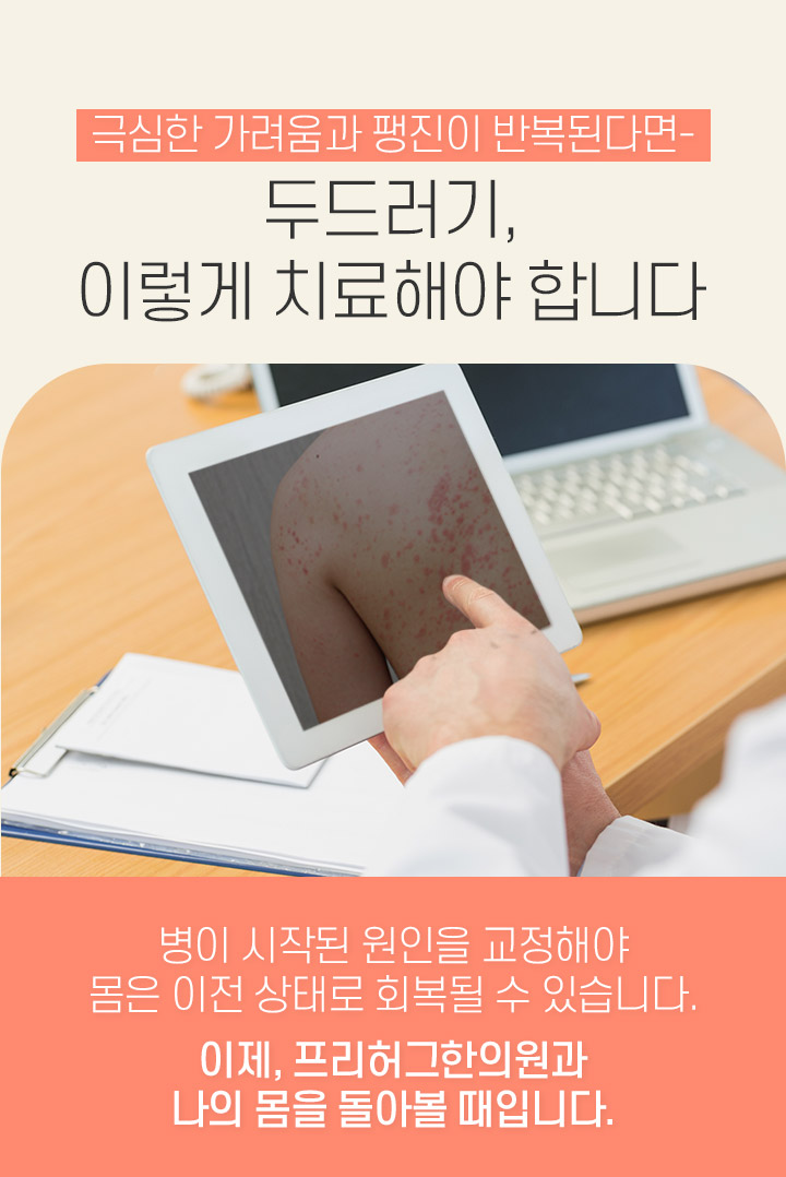 두드러기, 이렇게 치료해야 합니다