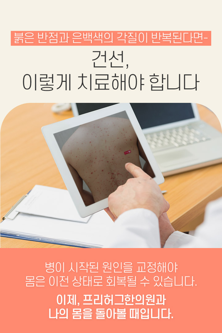 건선, 이렇게 치료해야 합니다
