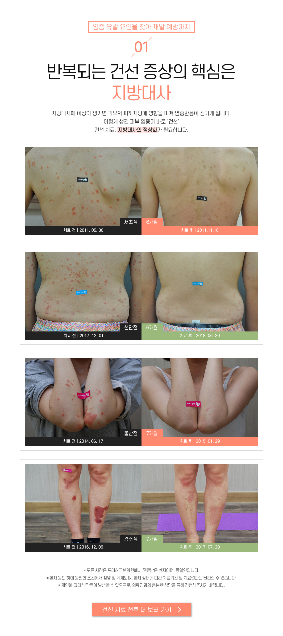 1. 반복되는 건선 증상의 핵심은 지방대사