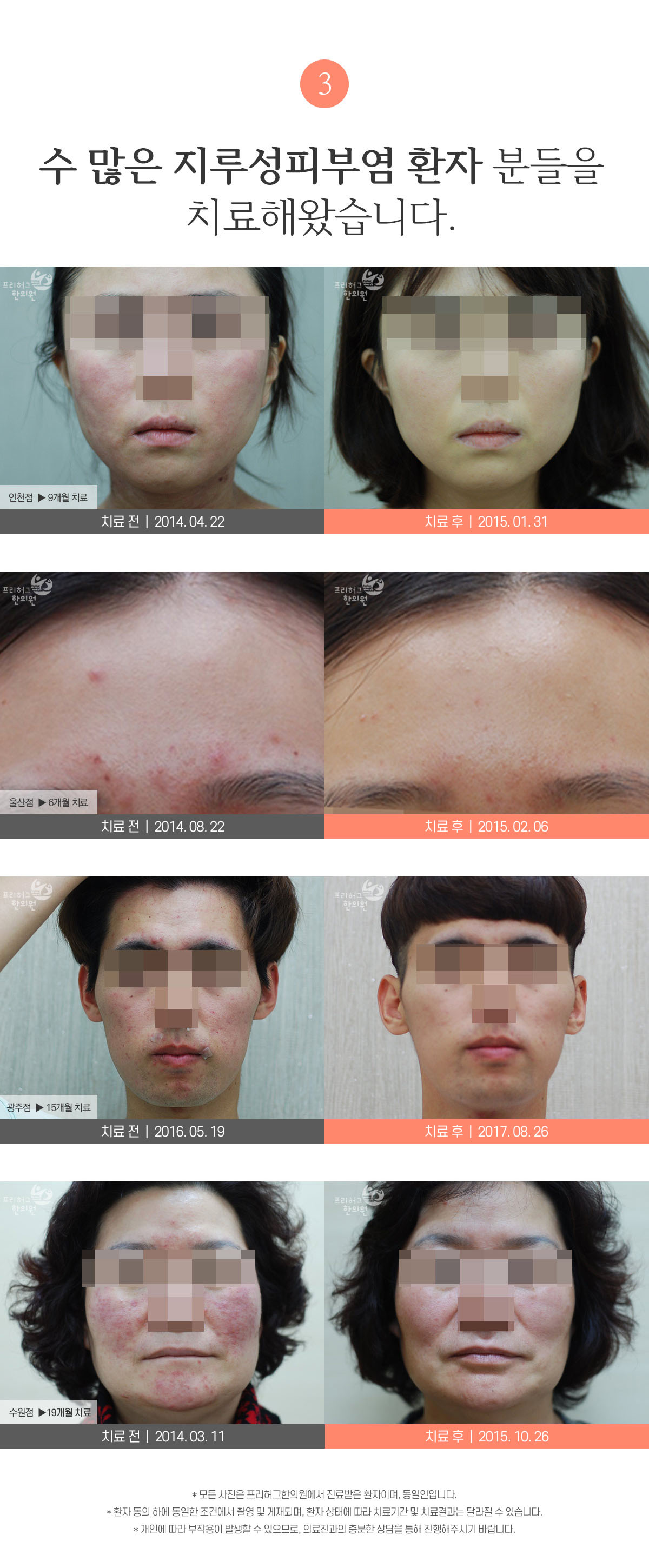 수 많은 지루성피부염 환자 분들을 치료해왔습니다