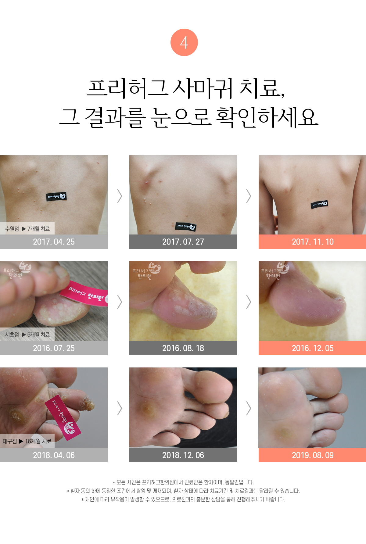 프리허그 사마귀 치료 그 결과를 눈으로 확인하세요 블로그로 지역환자와 직접 소통하는 한의사